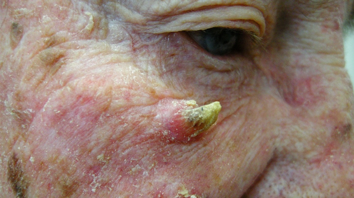 What Is a Cutaneous Horn on a Dog?